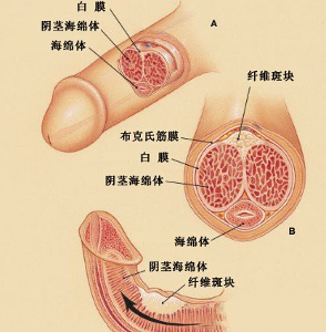 陰莖彎曲