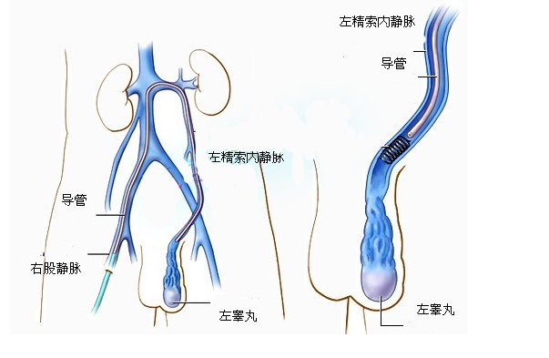 導(dǎo)致精索靜脈曲張有哪些病因